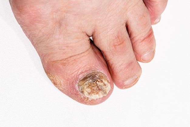 What kills toenail fungus fast? 