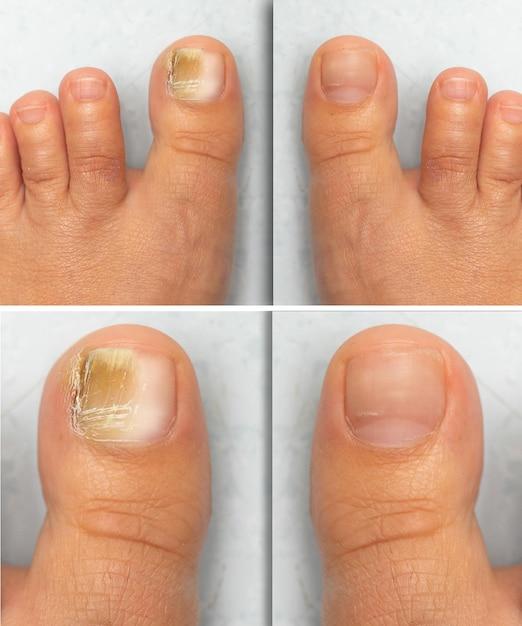 What kills toenail fungus fast? 