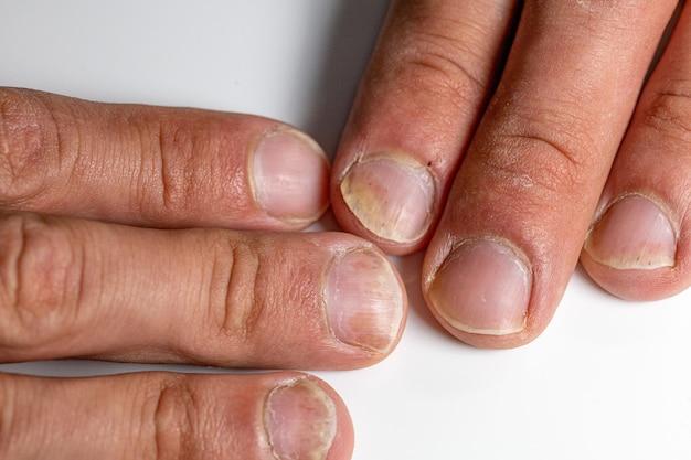 What Deficiency Causes Black Lines On Nails 